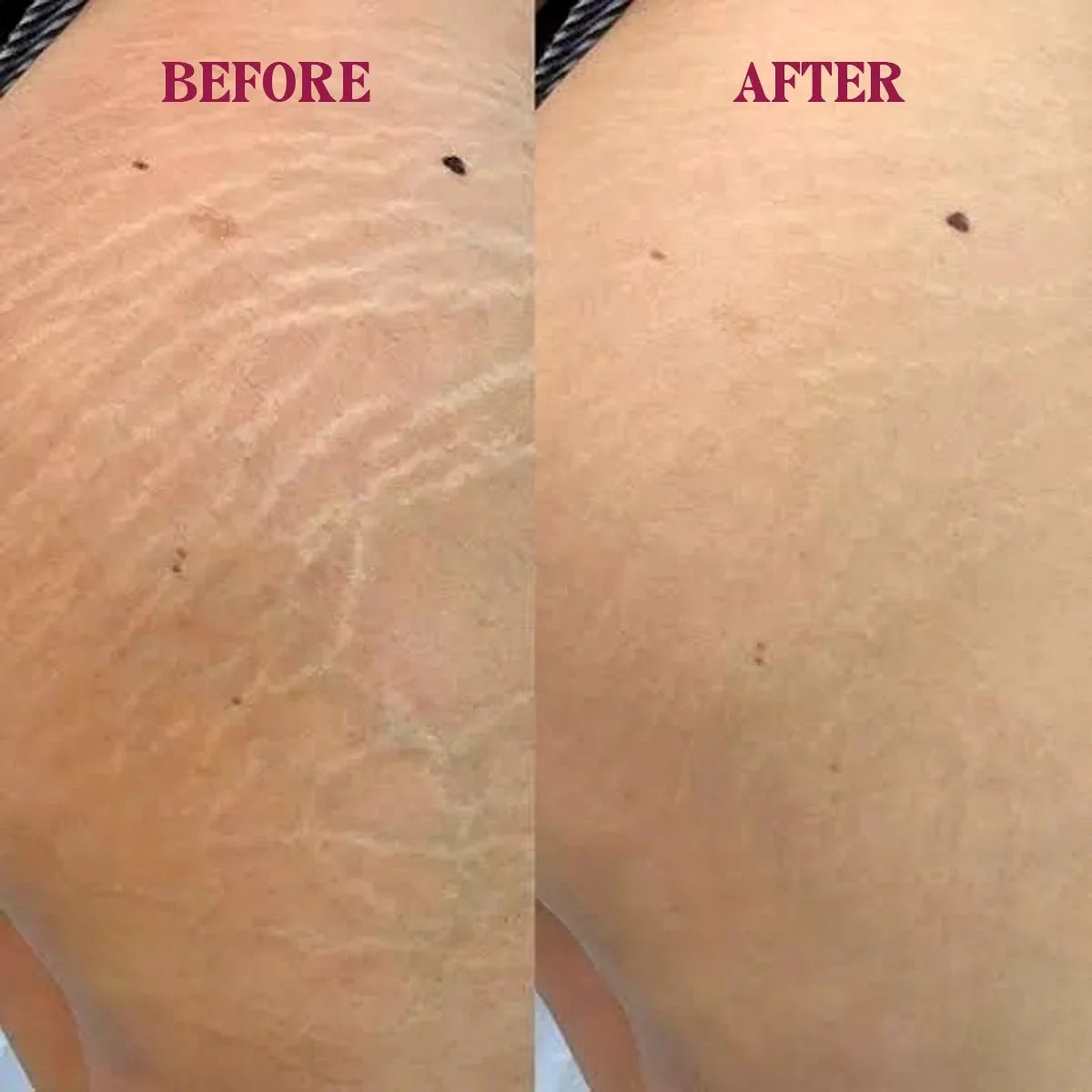 Markless Veil – Stretch Mark Serum - RaybyrafiaMarkless Veil – Stretch Mark SerumRaybyrafiaRaybyrafia1000Markless Veil – Stretch Mark SerumMarkless Veil – Stretch Mark Serum