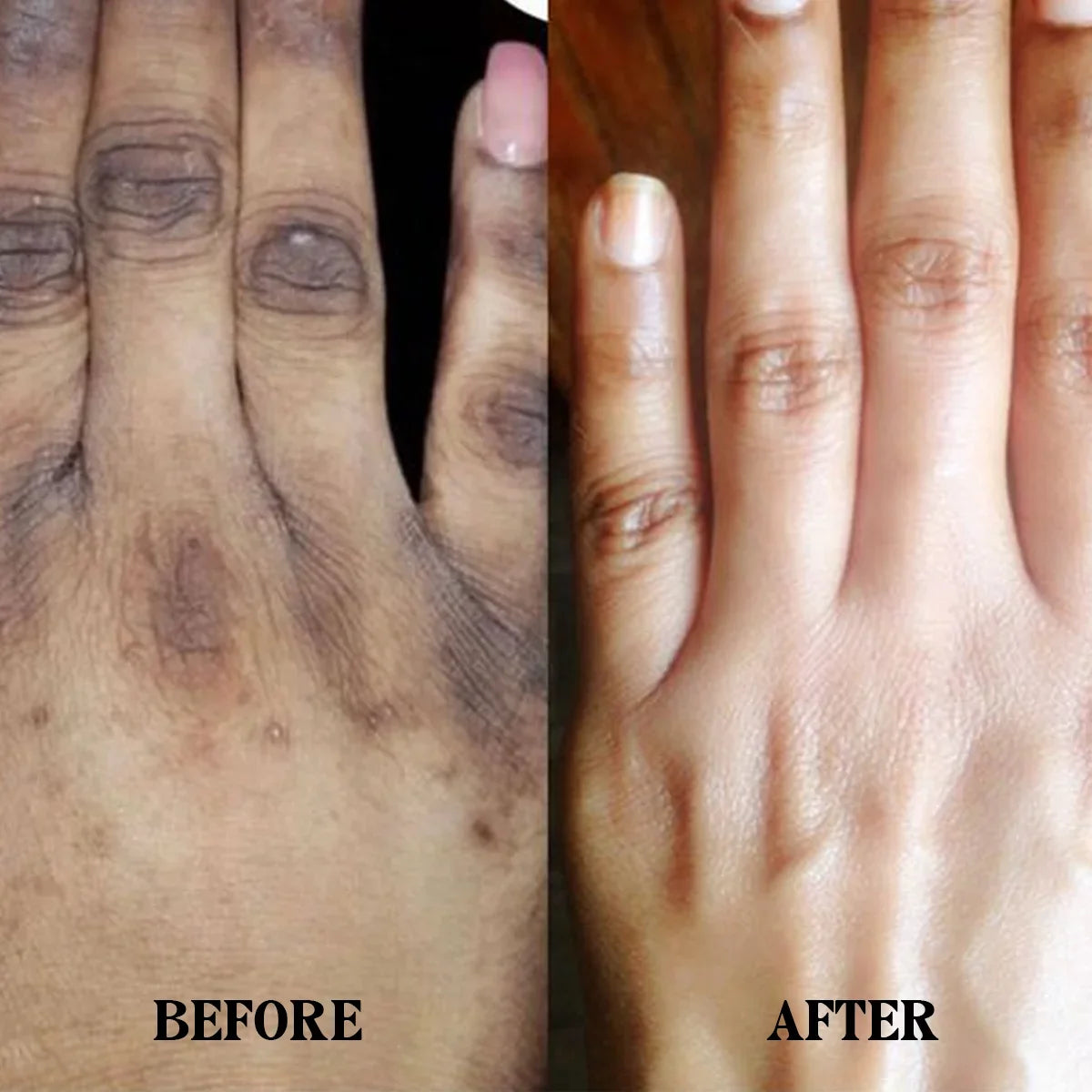Hand & Foot Spot Clearing 🤍
